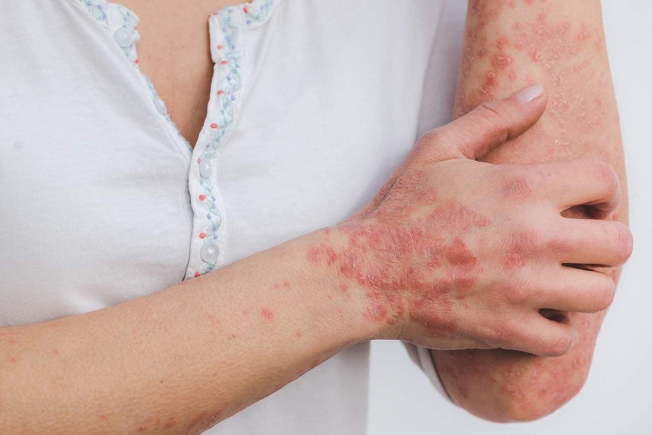 psoriasis on hand and arm